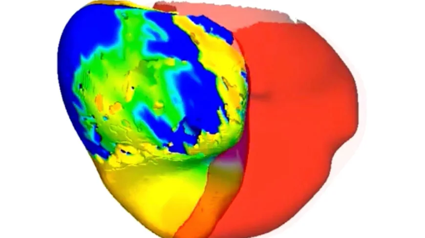 To fix a patient's irregular heartbeat, doctors first tested its digital 'twin'